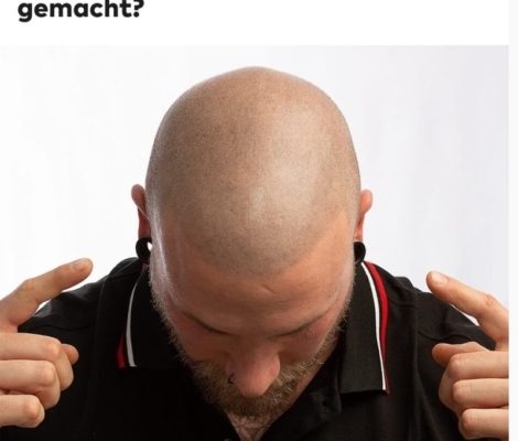 WELT: Haarpigmentierung – welche Erfahrung haben Männer mit der Methode gegen Haarausfall gemacht?