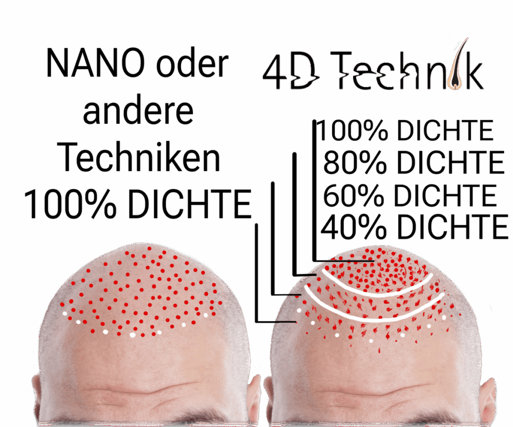 Scalp Micropigmentation, SMP und Nano-Haarpigmentierung im Vergleich zu 4D-Technik
